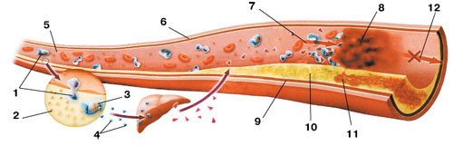 Отложение холестерина на стенке сосуда: 1 - моноцит; 2 - «плохой» холестерин; 3 - макрофаги; 4 - цитокины - сигнальные полипептидные молекулы; 5 - артерия; 6 - кровеносный сосуд; 7 - кровоток; 8 - тромб; 9 - внутренняя стенка артерии; 10 - бляшка на внутренней стенке артерии; 11 - разрыв бляшки; 12 - кровоток прерывается. Изображение: «Наука и жизнь»